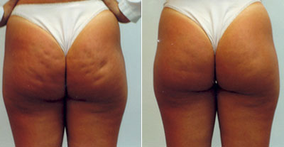 a narancsbőr stádiumai