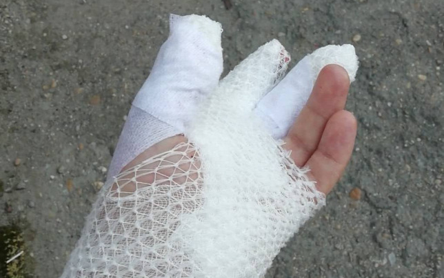 Letépte a petárda a fotós kezét