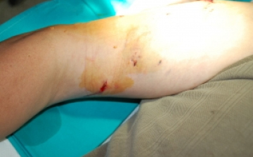 Az utcáján marcangolta a helyi férfit a kaukázusi juhászkutya