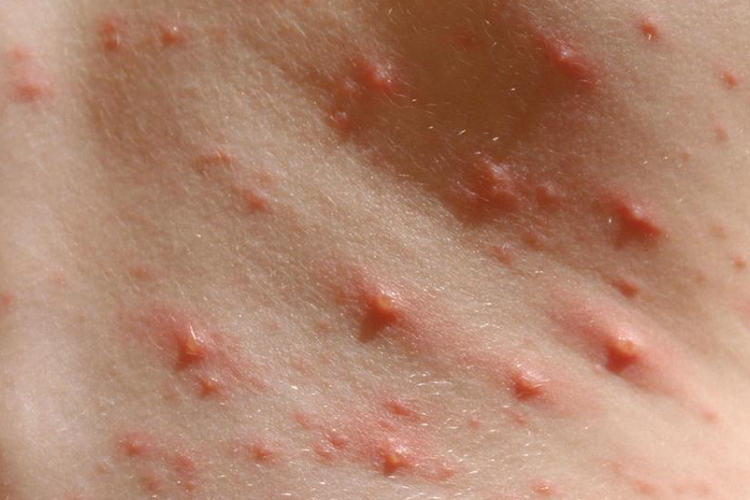 Kötelező lesz az oltás bárányhimlő ellen