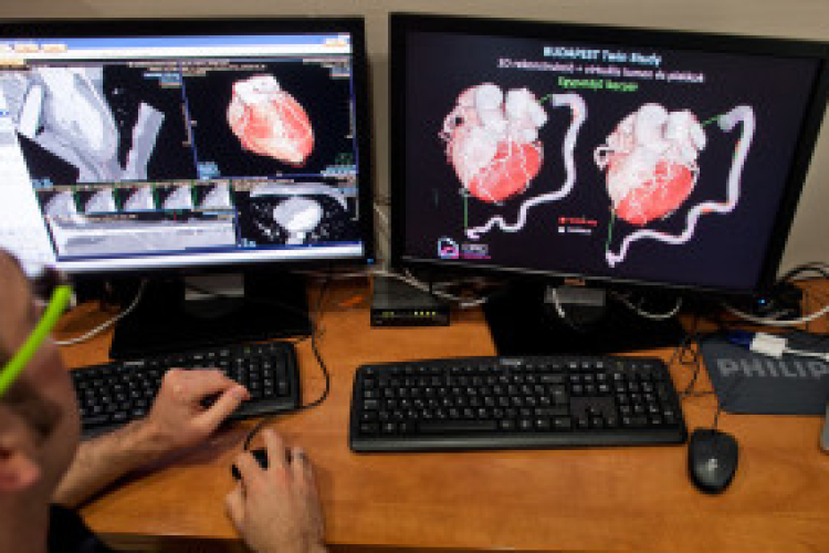 Szívinfarktus és öröklődés: egyedülálló kutatás ikrek körében