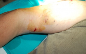 Az utcáján marcangolta a helyi férfit a kaukázusi juhászkutya