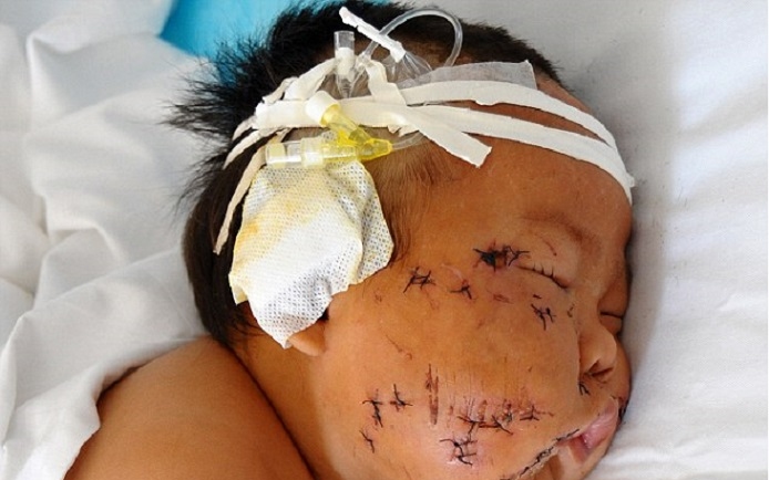 90 szúrást ejtett nyolc hónapos csecsemőjén a kínai anya