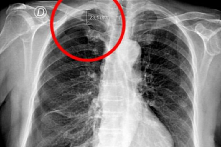 Veszélyes lehet az akupunktúrás kezelés