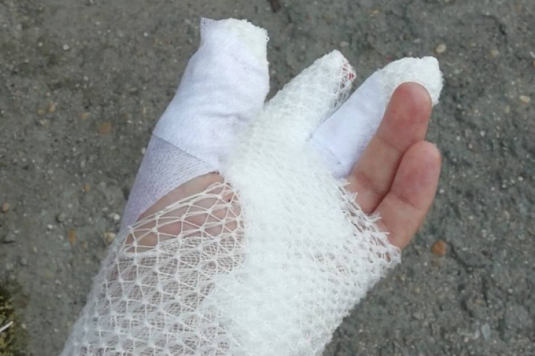 Letépte a petárda a fotós kezét